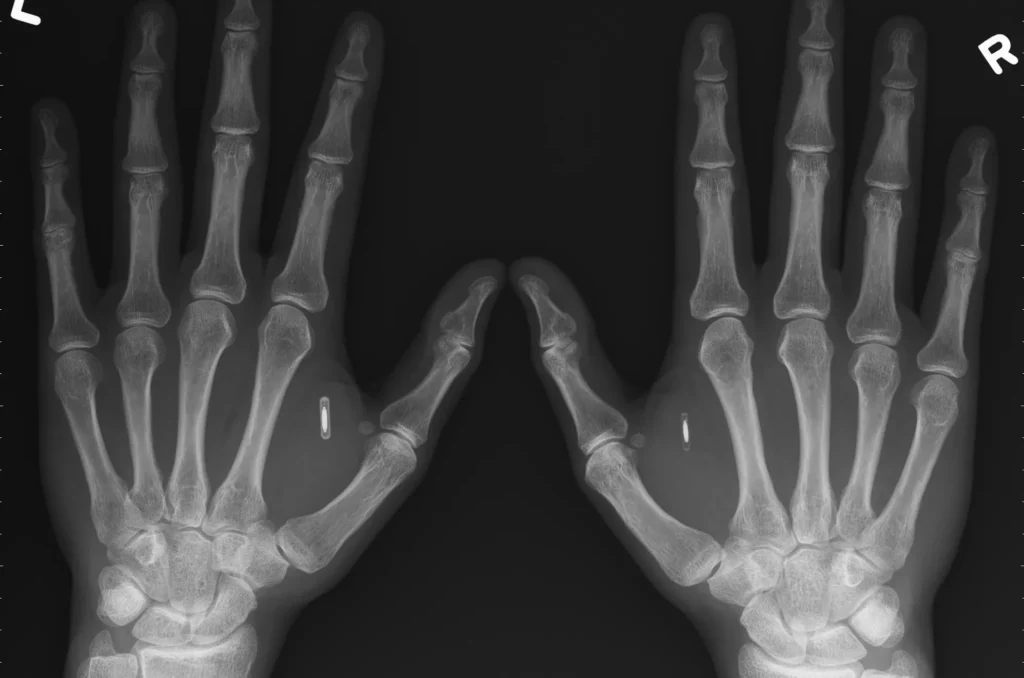 Radiografia dei microchip impiantati nelle mani
